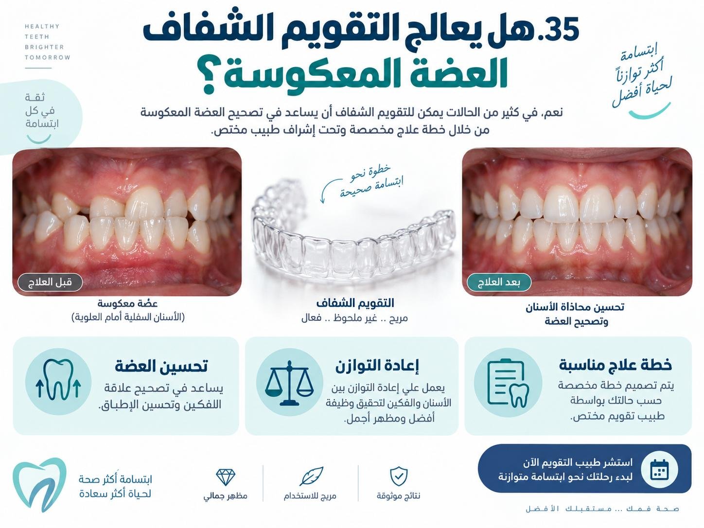 هل يعالج التقويم الشفاف العضة المعكوسة؟